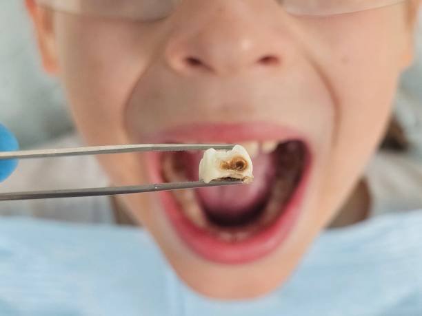 Best Emergency Root Canal Therapy in Eastpoint, FL